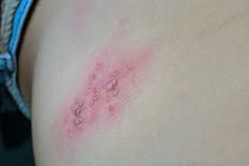 Image result for herpes zoster