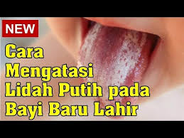 Setelah si kecil minum susu, terdapat bercak putih di lidahnya yang menetap dan tak kunjung lidah putih pada bayi merupakan dampak dari meningkatnya pertumbuhan jamur yang disebut cara mengatasi lidah putih pada bayi. Cara Mengatasi Lidah Putih Pada Bayi Baru Lahir Youtube