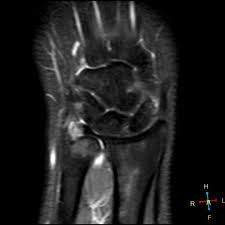 When someone describes an injury to the tfcc, they are describing an injury to these structures. Tfcc Injury Palmer 1b Radiology Case Radiopaedia Org