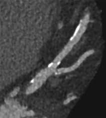 Matthew J. Budoff Stephan S. Achenbach Harvey S. Hecht Jagat Narula Editors  Second Edition