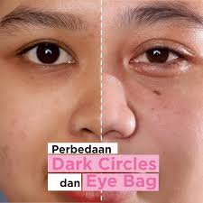 Mata adalah jendela jiwa” merupakan ungkapan tentang mata yang sering kita  dengar. Banyak orang yang mengira orang dengan dark circle itu kelelahan  dan banyak beban hidup, padahal terkadang masalahnya hanya karena keadaan
