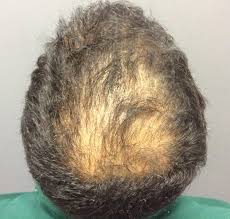 What are hair loss causes? Hair Loss Village Dermatology