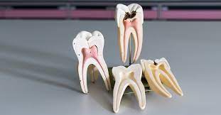 If decay is left untreated, it can kill the tooth from within and necessitate a tooth extraction. The Do S And Don Ts Of Root Canal Aftercare