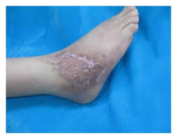 Treatment Of Nonhealing Diabetic Lower Extremity Ulcers With Skin Graft And Autologous Platelet Gel A Case Series