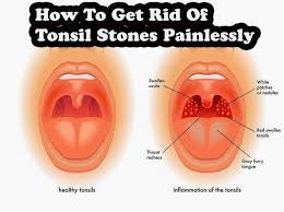 How to get rid of white spots on teeth at home. How To Get Rid Of White Spots On Tonsils Top Ways To Remove Tonsil Stones