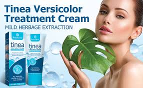 Roycederm Tinea Versicolor Treatment, Antifungal Cream for Tinea Versicolor  & Pedis, All-Natural Athletes Foot Treatment Ringworm Treatment for Humans,  Fast Healing Anti Fungal Skin Cream : Amazon.co.uk: Health & Personal Care