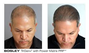 Hair regrowth treatment for women. Bosley Hair Transplant Restoration 156 Photos 14 Reviews Hair Loss Centers 676 North Michigan Avenue Chicago Il Phone Number Yelp
