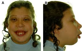 Cherubism is a hereditary disease which is histologically similar to central giant cell granuloma occurs due to the following reasons: Orthognathic Surgery In Cherubism Journal Of Oral And Maxillofacial Surgery