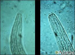 Hookworm Infection Information Mount Sinai New York