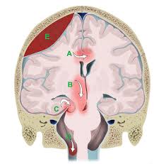 A 35 Year Old Man In A Crash Usmle Question