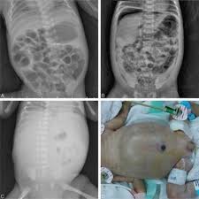 Image result for Necrotizing Enterocolitis