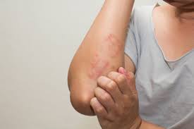 Image result for Atopic Dermatitis