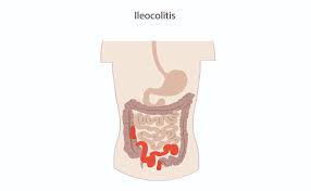In the hindi language, some words are commonly used in a number of different ways, or used in ways that don't reflect their literal meaning. What Is Ileocolitis Crohn S Disease Ibdrelief