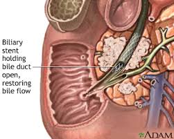 Medical illustration of a biliary stent in the bile duct restoring bile flow into the duodenum
