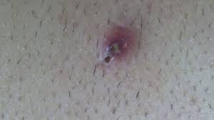 A bump on your head with hair trapped happens when the sharp edges of the hair grow downwards or sideways back cutting into the skin of the hair follicle. Blackhead Or Ingrown Hair Youtube