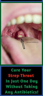 12 Effective Natural Home Remedies To Treat A Strep Throat Infection Strep Throat Strep Throat Remedies Natural Throat Infection