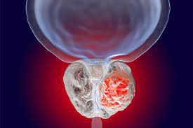 Waking at night to urinate. Overactive Bladder In Men With Newly Diagnosed Localized Prostate Cancer