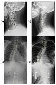 HTN: Hybrid Transformer Network for Curvature of Cervical Spine Estimation