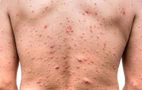 Image result for herpes zoster