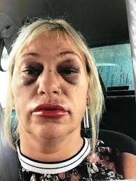 I was beaten to a pulp by my monster ex then he was freed after 8 weeks  jail'