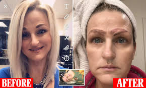 Our laser hair removal gets rid of unwanted body hair. Mother Is Dumped After Botched Microblading Left Her With Four Eyebrows Daily Mail Online