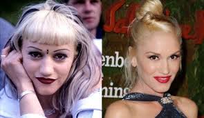 Celebrity Plastic Surgery 30 Before And After Pics Celebrity Surgery Celebrity Plastic Surgery Hair Implants