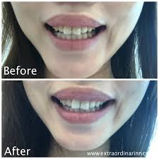 Do you want to whiten your dull, boring, yellow teeth? Carinn Carerynn Malaysia Fashion Beauty Lifestyle Blog Tag Dental Clinic Dental Scaling And Polishing In Johor Bahru