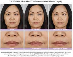 Check spelling or type a new query. Juvederm Dermal Fillers In Beverly Hills Rebecca Fitzgerald Md