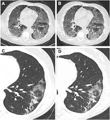 Looking for the definition of ldct? Proposal Of A Low Dose Long Pitch Dual Source Chest Ct Protocol On Third Generation Dual Source Ct Using A Tin Filter For Spectral Shaping At 100 Kvp For Coronavirus Disease 2019 Covid 19 Patients A Feasibility Study