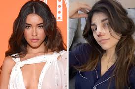 Here's what you need to know about which ones to try and how they stack up to other ha dermal fillers. Madison Beer Responds To Cosmetic Surgery Allegations