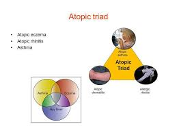 Image result for Allergic Triad