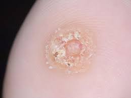 Maybe you would like to learn more about one of these? Can You Recognize Plantar Warts On Feet