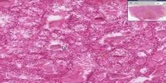 An infiltrative ophthalmopathy with resultant exophthalmos. Thyroid Histology Of Hyperthyroid Graves Disease Dnatube Com Scientific Video And Animation Site