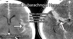 Image result for Subarachnoid Hemorrhage