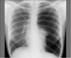 A pneumothorax occurs when air leaks into the space between your lung and chest wall. Ø§Ø³ØªØ±ÙˆØ§Ø­ Ø§Ù„ØµØ¯Ø± Ø£Ùˆ Ø§Ù„Ø±ÙŠØ­ Ø§Ù„ØµØ¯Ø±ÙŠØ© Pneumothorax Ø£Ø³Ø¨Ø§Ø¨Ù‡ ÙˆØ£Ø¹Ø±Ø§Ø¶Ù‡ ÙˆØ¹Ù„Ø§Ø¬Ù‡