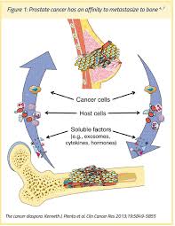 Bone Metastases And Mortality In Prostate Cancer Can We Be Doing More Full Text Article