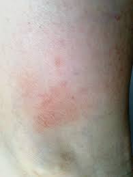 Krasnoe Pyatno Na Noge Pri Nadavlivanii Beleet Vopros Dermatologu 03 Onlajn