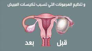 الأمراض النسائيه الأكثر شيوعا و طريقة علاجها عيادة طبيعتي للحجامة youtube