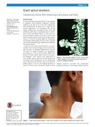 Neck masses in children, neck mass in the child, pediatric neck mass. Pdf Giant Spinal Exostosis