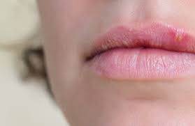 Hausmittel gegen kopfschmerzen können nicht alles. Lippenherpes Verlauf Dauer Lippenherpes Ratgeber