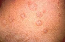 Hautarztpraxis Dr Hempel Pityriasis Rosea