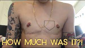 However, the timing of this surgery may need to be flexible, as it is not performed in response to an acute medical need. How I Paid For My Top Surgery Youtube