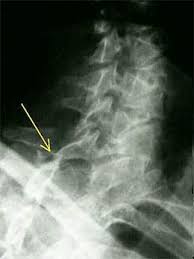 Open in a separate window. Facet Joint Injury And Whiplash North Alabama Spine Rehab