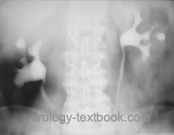 Image result for Genitourinary Tuberculosis