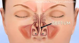 The nasal cavity also contains structures to detect chemical odorants and resonate the voice. Perforated Septum Dr Hamilton Surgical Repair Of A Hole In The Septum