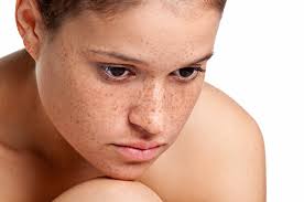 What is melasma / melasma definition. Freckles Hyperpigmentation Natural Ayurvedic Treatment Melbourne