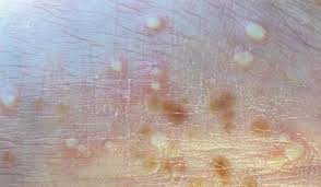 Image result for Pustular Psoriasis