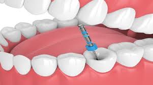 After a root canal, patients will want to make sure of a few things: 8 Great Tips Provided By Dentist In Croydon For Quick Root Canal Recovery