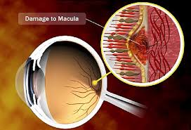 Video On What Is Macular Degeneration