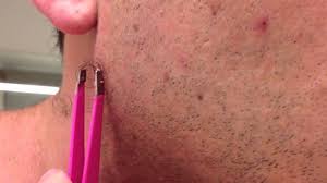 Having problems with inflamed, ingrown hair? Video The Most Watched Ingrown Hair Removal On Youtube Insider